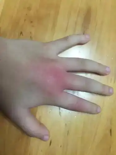 被蜈蚣咬过的伤口图片