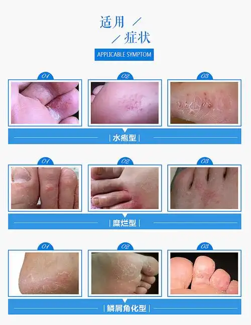 【3只装】澳洲进口 lamisil cream真菌足癣/脚癣/脚气膏/香港脚药膏15