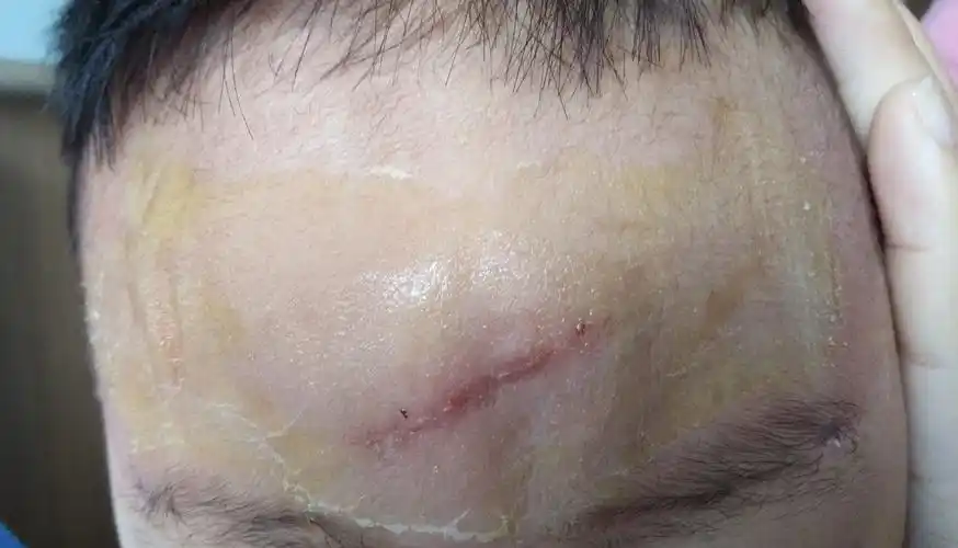 再如下面的缝合图片术前伤口术中缝线伤口下穿过对合伤口!