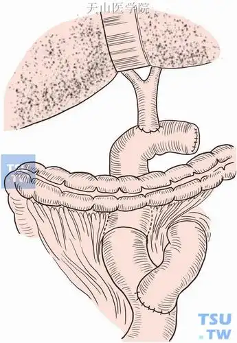 胆总管空肠吻合术