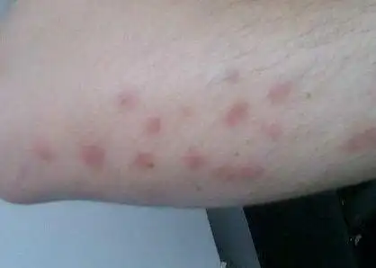 儿童登革热症状图片