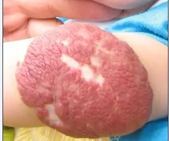 婴儿海绵状血管瘤