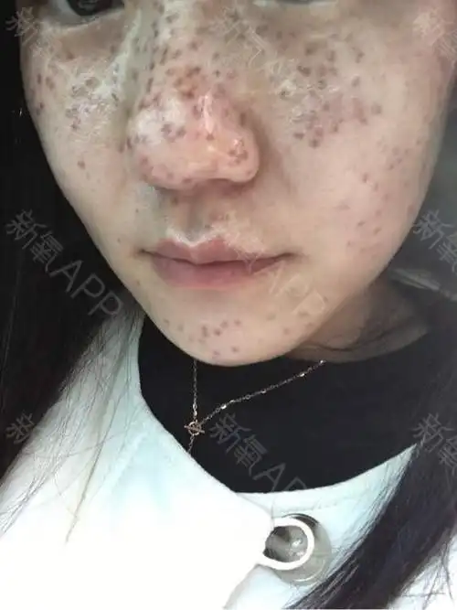 今天第三天,看去和前两天差不多,我每天都会涂药膏