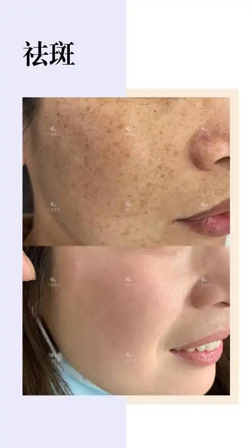 不要再相信任何祛斑小妙招了,治疗雀斑最有效的办法是激光