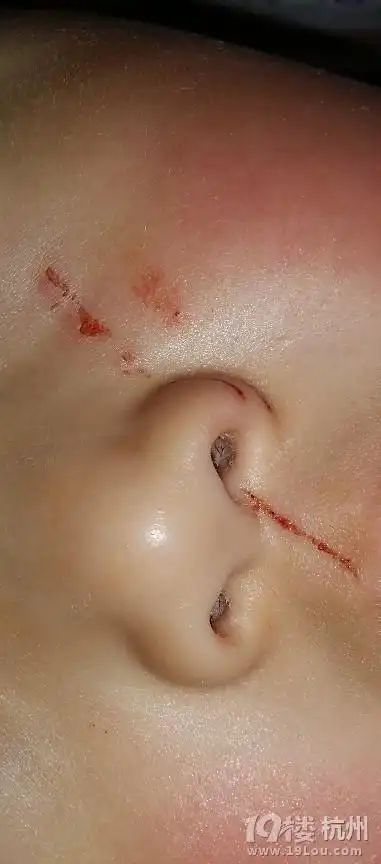 孩子在幼儿园被抓破脸,很严重担心留疤啊