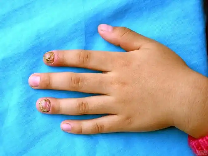 求助5个多月小孩脸上一小红包,一破流血不止