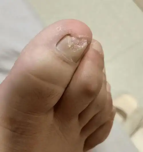 一个月灰指甲轻轻松松根除!