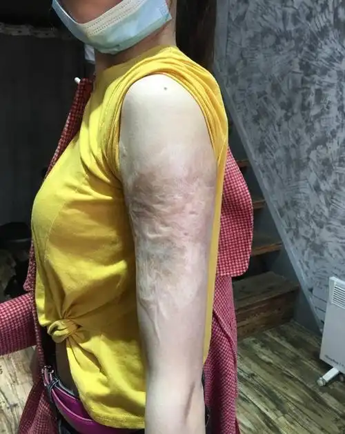 疤痕遮盖纹身图片_手臂纹身图案