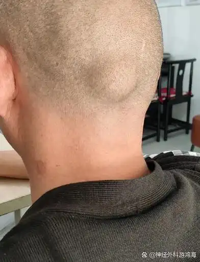 头后面有个凸起的骨头,常见原因包括骨质增生,枕骨粗隆或颅骨外伤