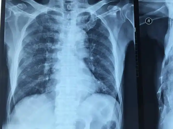 肺结核 - 好大夫在线