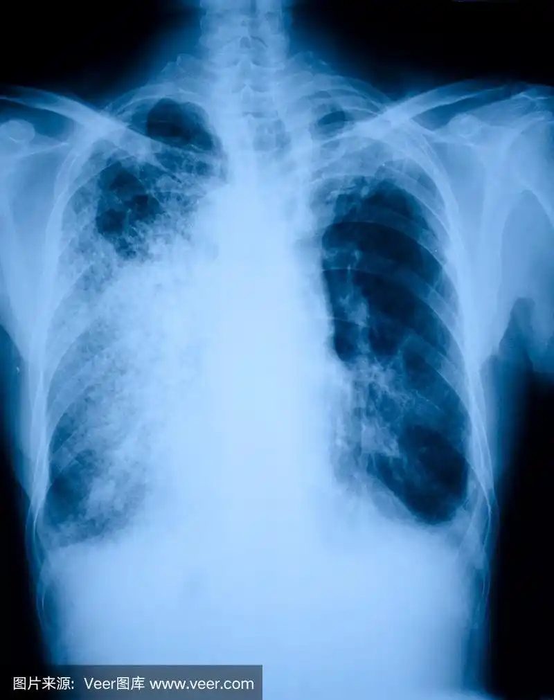 肺炎患者x线片