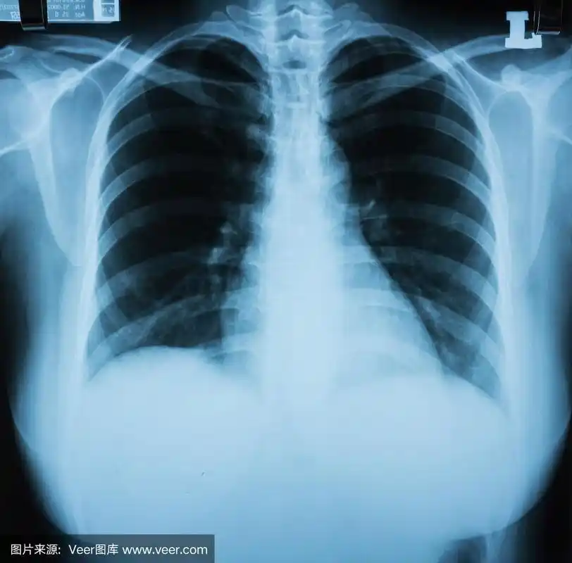 正常的胸部x光片