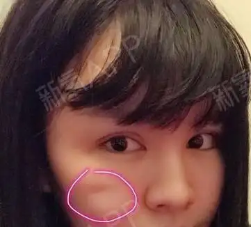 脸部线雕后有一边有凹老公要和我离婚,线雕凹陷4个月能恢复吗?