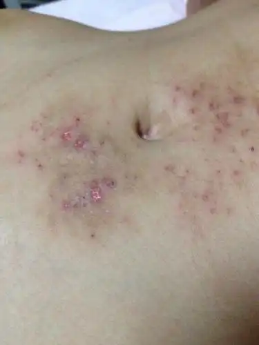 肚脐那里爱长疙瘩很痒,抠破皮就流水,以前长过,擦了些药好了,今年到了