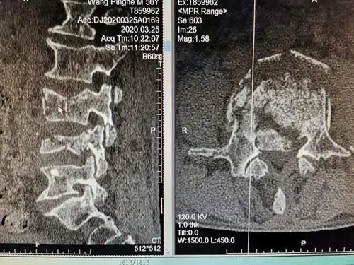 ct显示腰4椎弓根右侧破坏左侧完整,腰3双侧椎弓根完整