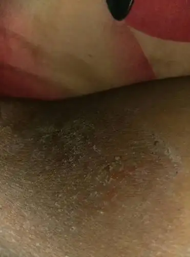 大腿根部好痒,有时候痒抓的时候还脱皮结了壳,是不是癣啊,用什么药好