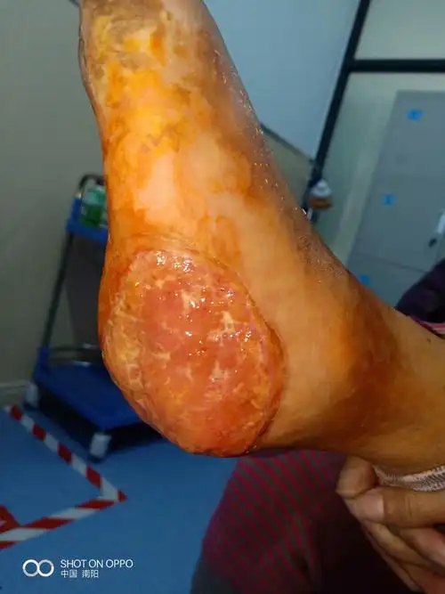 报道 写美篇小结:第一,恶性肿瘤切除后二期治疗再生医疗技术是首选,第