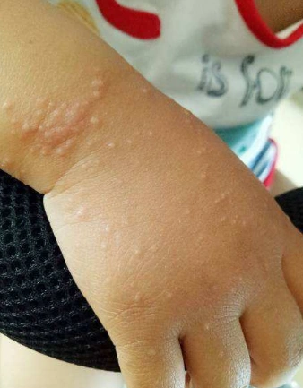 六盘水疣专家_六盘水治疗疣哪个专家好_六盘水治疗疣最