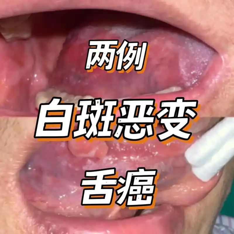白斑 #舌癌 #口腔癌 #口腔科普 #癌 - 抖音