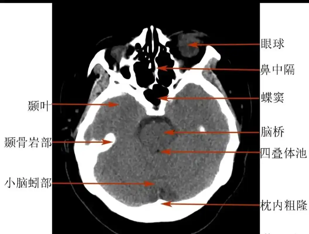 正常头颅ct.#愿所有人平安健康 #医学科普 #健康 - 抖音
