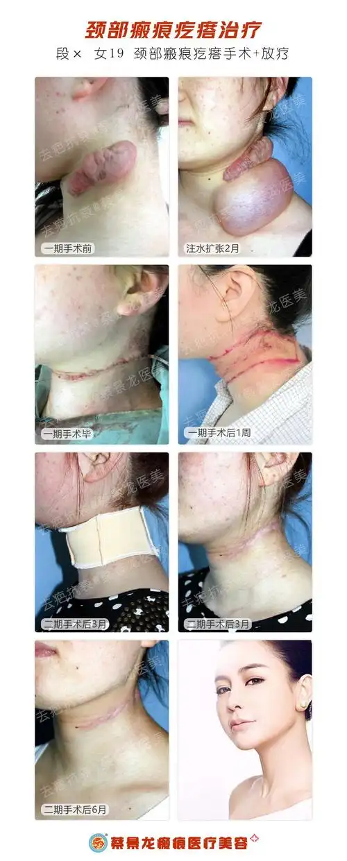 颈部疤痕疙瘩皮肤扩张术治疗 - 美篇