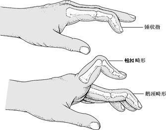 鹅颈畸形表现为手指基底部关节的内弯(屈曲),中间关节的伸直(伸展)
