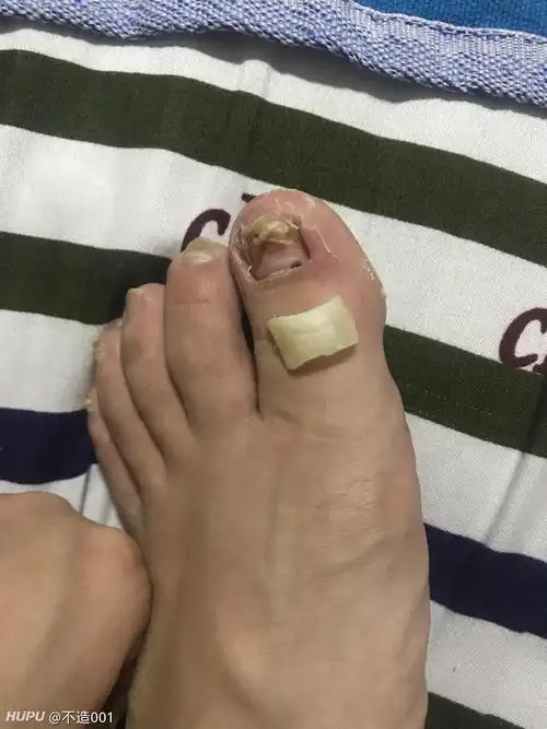 前几天打篮球大拇指甲盖掉了,结果新长出来的指甲.