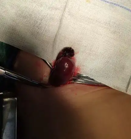 勿以疝小而不为 小儿腹股沟斜疝知识解答_小儿疝气_介绍_症状表现