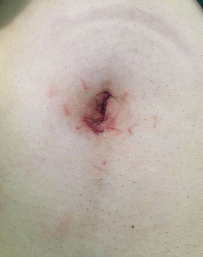 通过检查,很快诊断是急性宫外孕并伴有内出血,需进行单孔腹腔镜手术