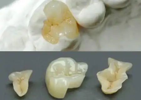 牙齿掉了一块,真的没关系吗?