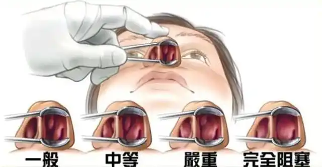 为什么我用鼻喷感觉作用不大?方法不对效果大打折扣_鼻腔