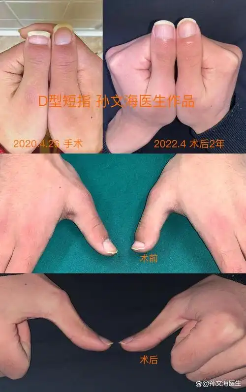 d型短指症的手术方法(附案例集)