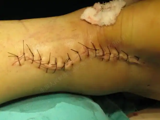 脚筋断了人就废了其实很多人的跟腱是被自己搞断的