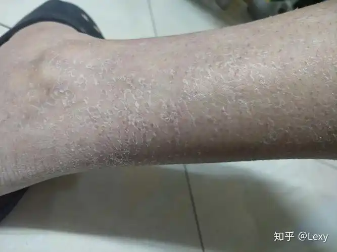 干货沙漠干皮鱼鳞皮肤怎样缓解没见过鱼鳞皮肤的慎点