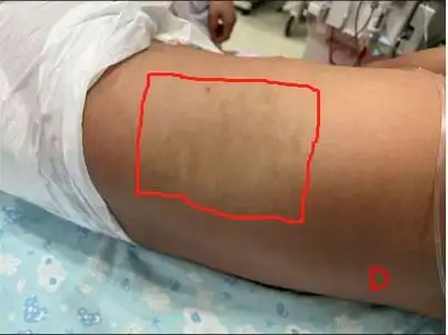 患儿吃太多被送icu住院1个月出院后又复发这是怎么了