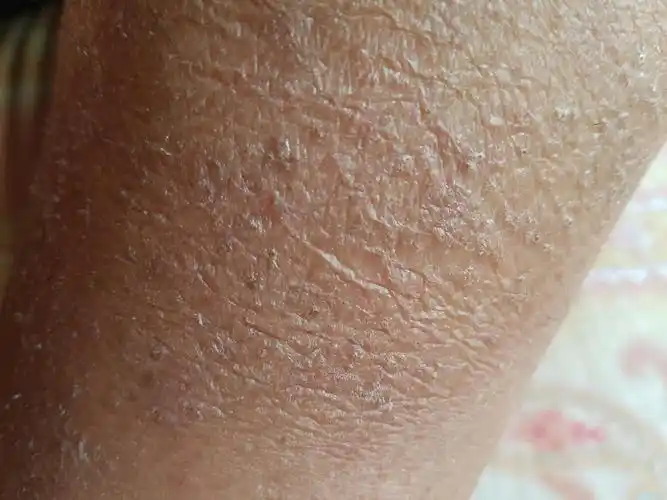 湿疹,结痂掉了以后,皮肤干皱,怎么恢复,有和我一样的吗?