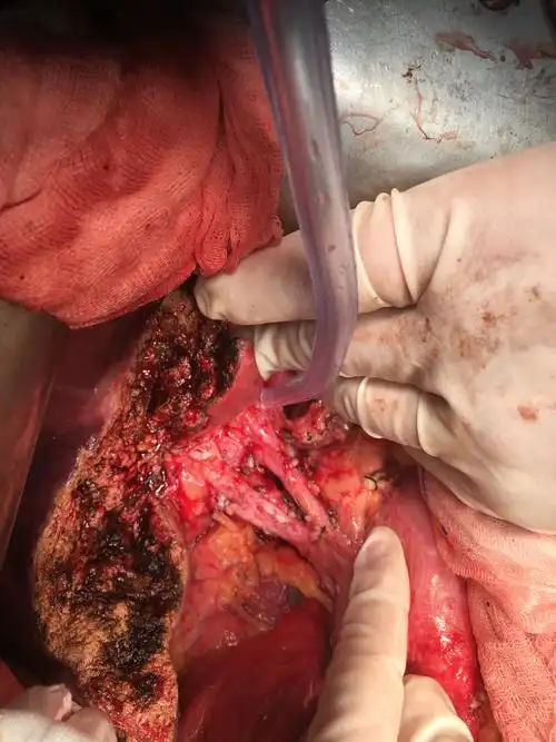 胆囊癌(胆囊癌最明显的一个征兆)