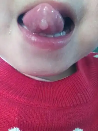 宝宝舌头下长了一个肉疙瘩是怎么回事