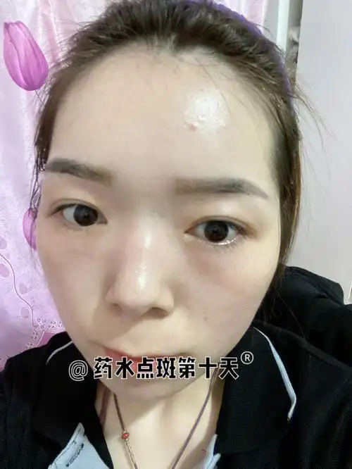 第二次药水点斑第十天