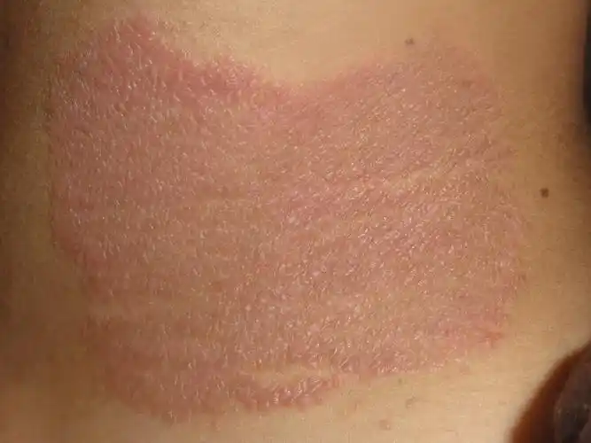 颈侧神经性皮炎