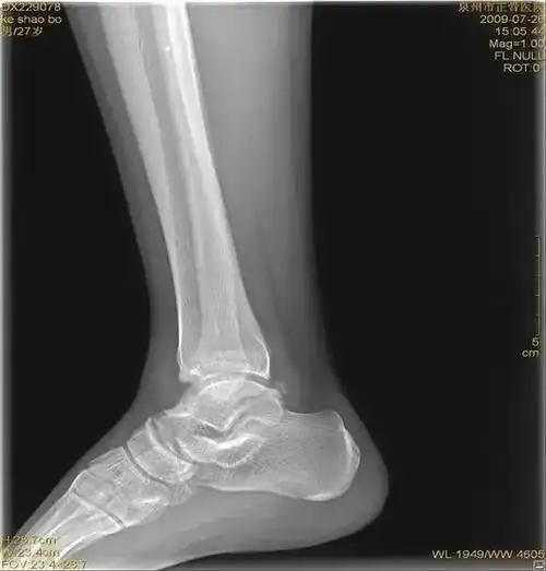 临床必备 | 踝关节扭伤的急救处理