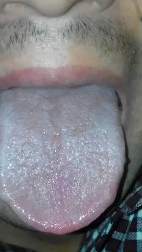 请问霉菌性食管炎和浅表胃炎有打嗝,稍微恶心的症状吗?