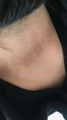 脖子后面有一道这个黑线是什么原因