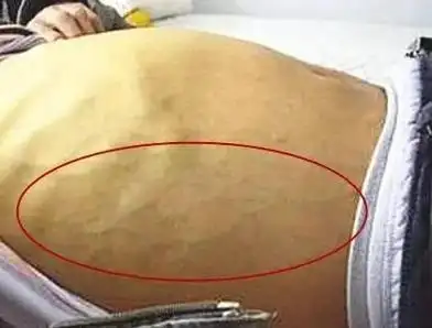 身上这几处有青筋?说明疾病已盯上你