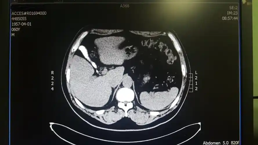 一例充满型胆囊结石的保胆治疗