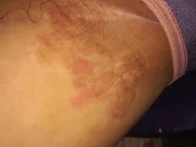 大腿内侧长红斑,痒痒的,左右两个大腿都有,过一段时间不痒了就变黑斑