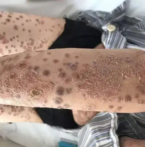 闫玉红健康课堂皮肤病都容易传染皮肤病专家这样说