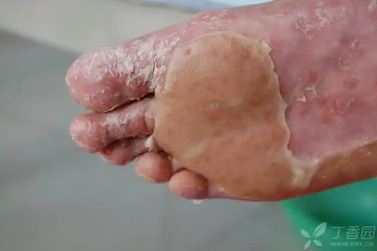 银屑病30余年长期口服维a酸,双足反复脱皮3年伴右足内踝创面反复.