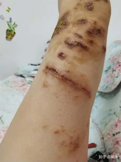 被海蜇蛰伤已经4个多月了这几天又复发了有经验的探讨一下怎么才能好