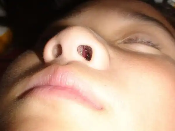 求助女儿鼻子到底是什么病